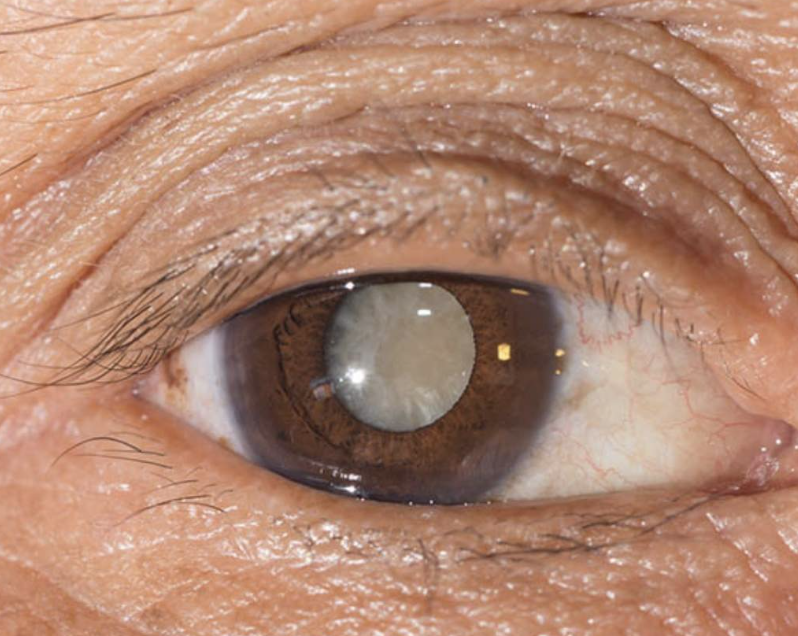 Paciente com catarata no olho