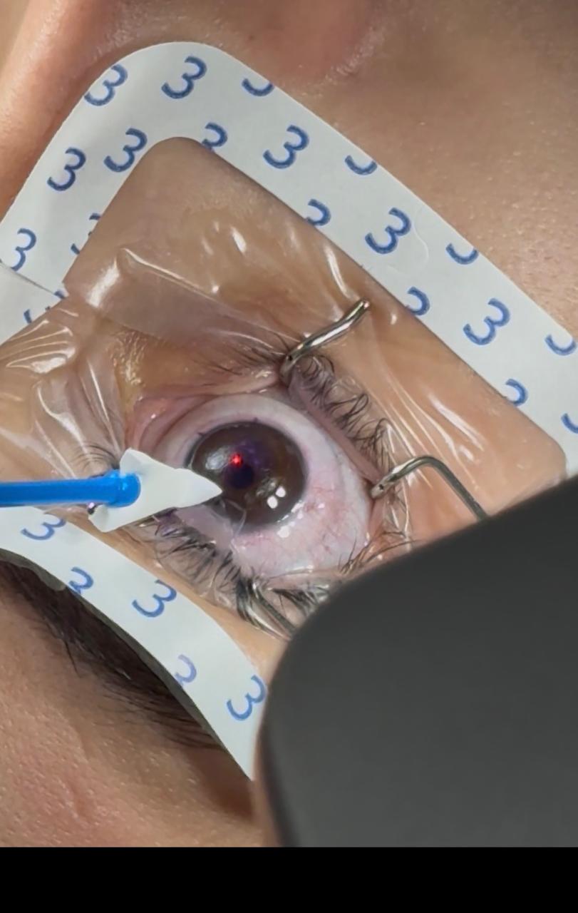 Cirurgia refrativa a laser