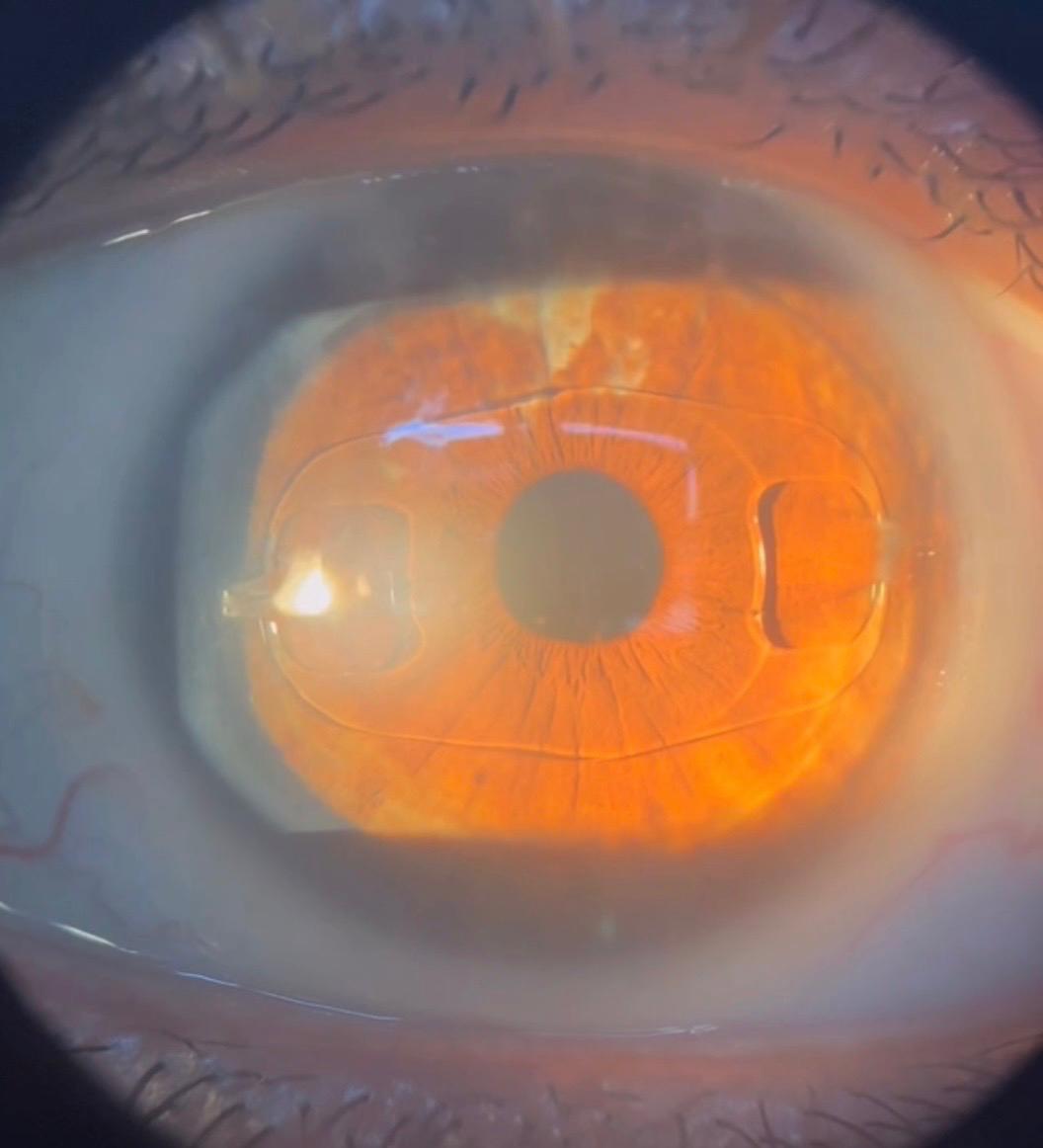 Lente intraocular fácica